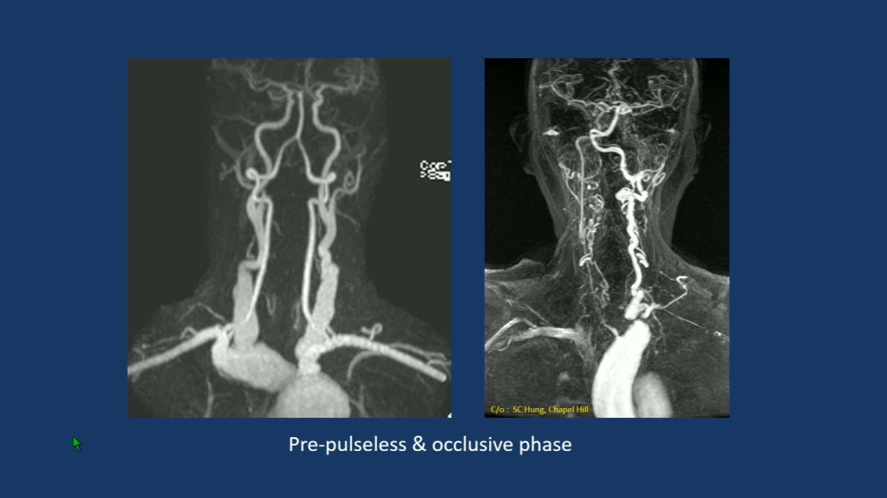CNS Vasculitis: Basics to Advanced