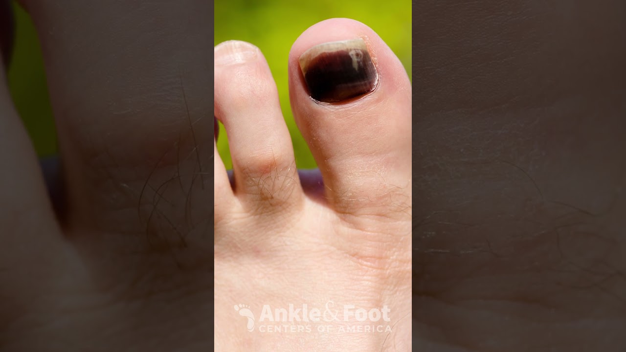 Purple Toenails: Causes, Treatments, and Prevention | Ankle & Foot Centers of America