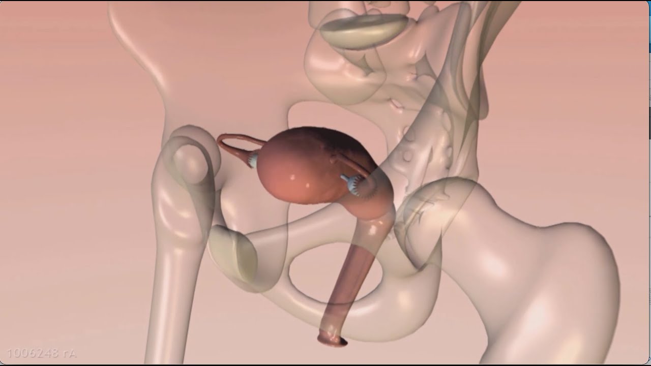 Isterectomia semplice con Robot Da Vinci