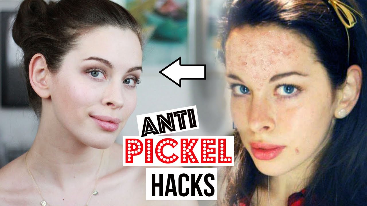 Beste ANTI PICKEL HACKS: PICKEL über NACHT WEG, DIY Pickelmale AUFHELLEN | LIVE TEST unreine Haut