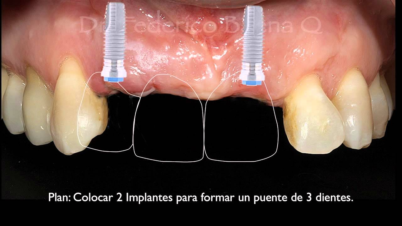 Transformando Sonrisas | Implantes Dentales en Querétaro | Dentista en Querétaro