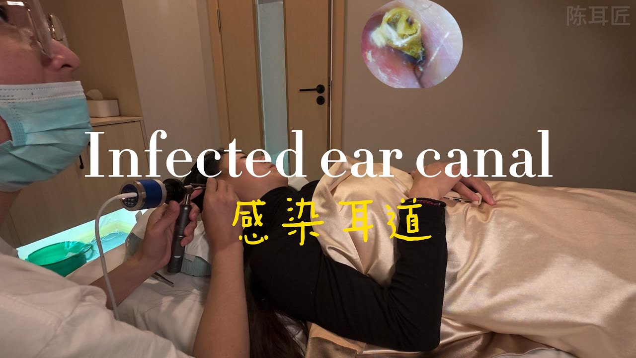 Infected ear canal cleaning 感染耳道清理#ear #可视采耳