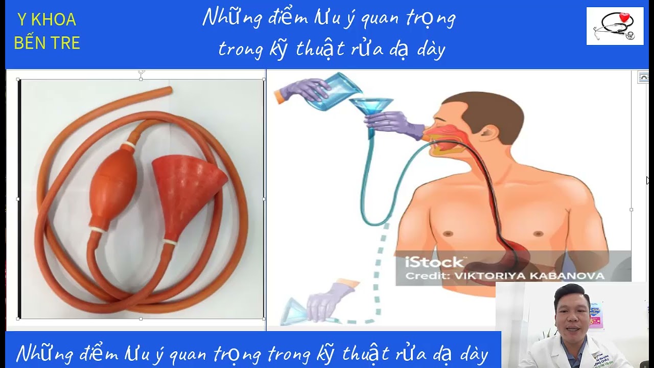 Những điểm lưu ý quan trọng trong kỹ thuật rửa dạ dày