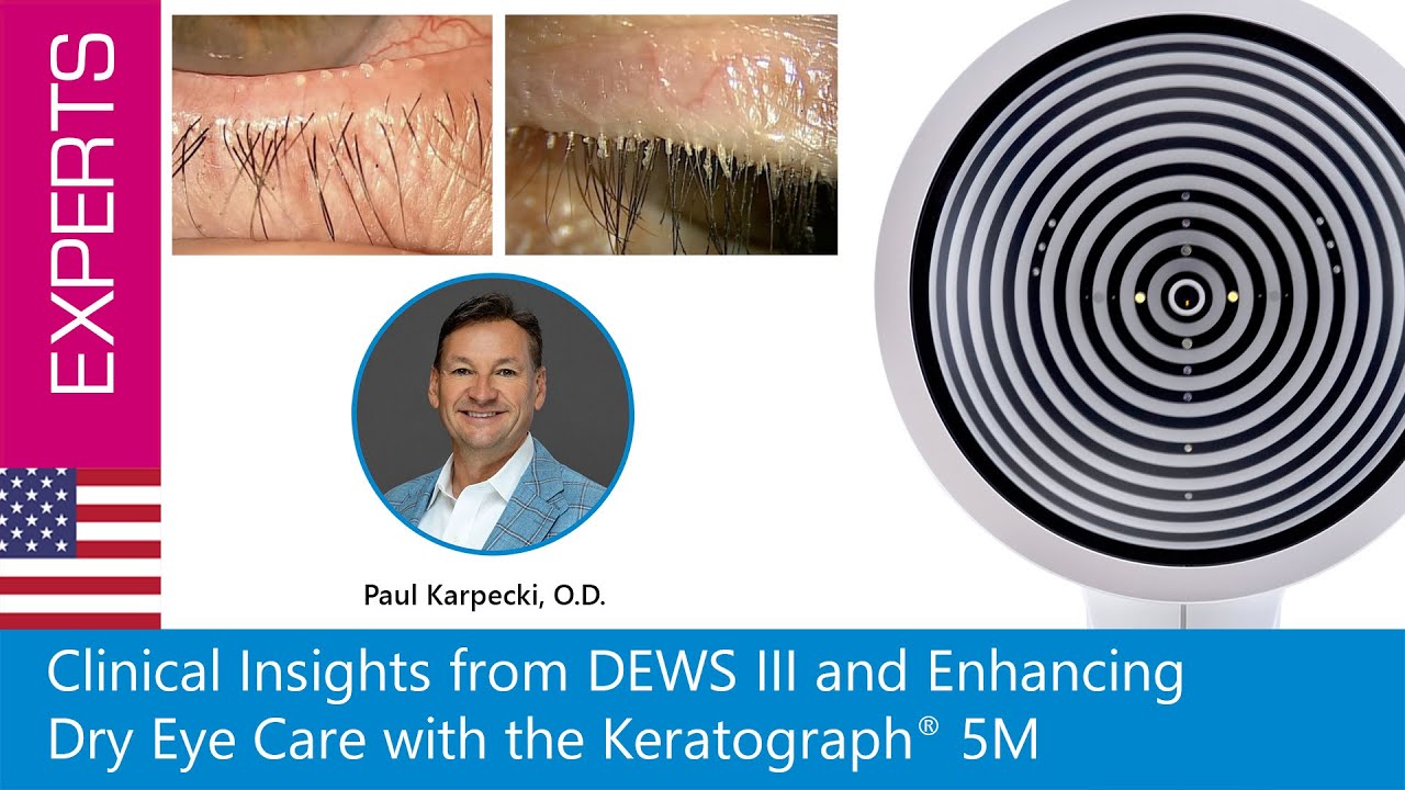 Clinical Insights from DEWS III and Enhancing Dry Eye Care with the Keratograph® 5M