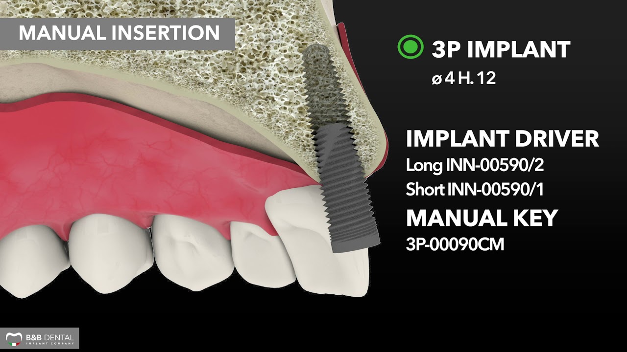 B&B Dental | Compactor expander protocol - D3-D4 bone - 3P implant line