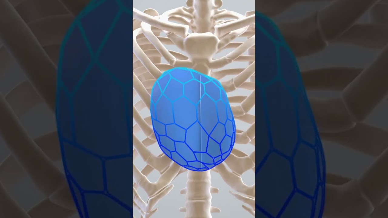 PEKTUS Ekskavatumda 3D IMPLANT Tedavisi #pectusexcavatum #kunduracıgöğsü #pektus #pektusekskavatum