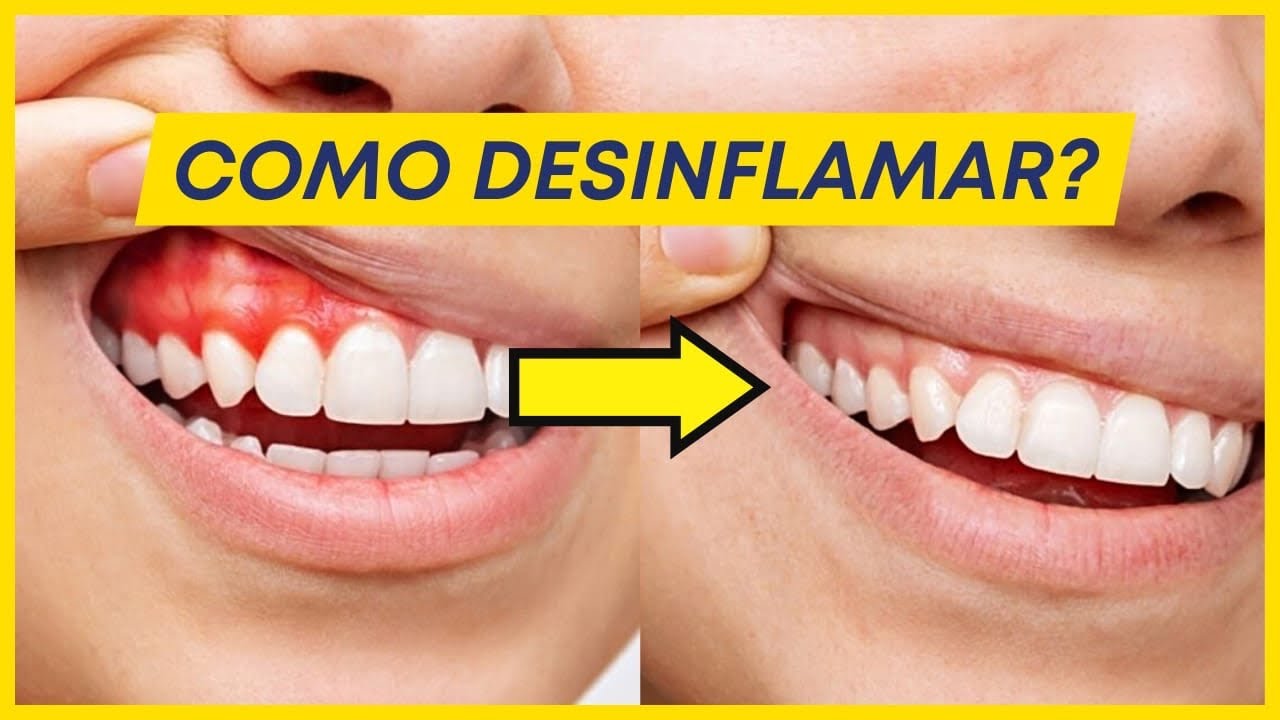 COMO TRATAR A GENGIVA INFLAMADA DO PACIENTE?