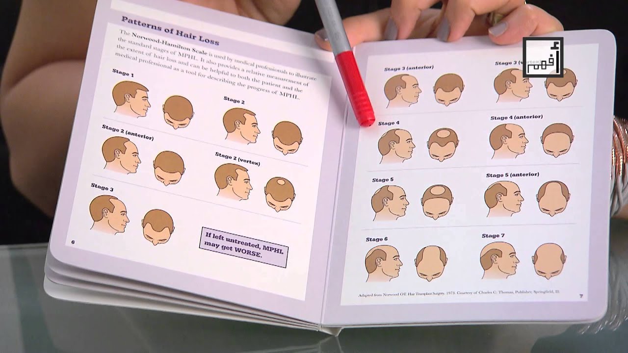 Alyaa Gad - Male Pattern Hair Loss | الصلع عند الرجال