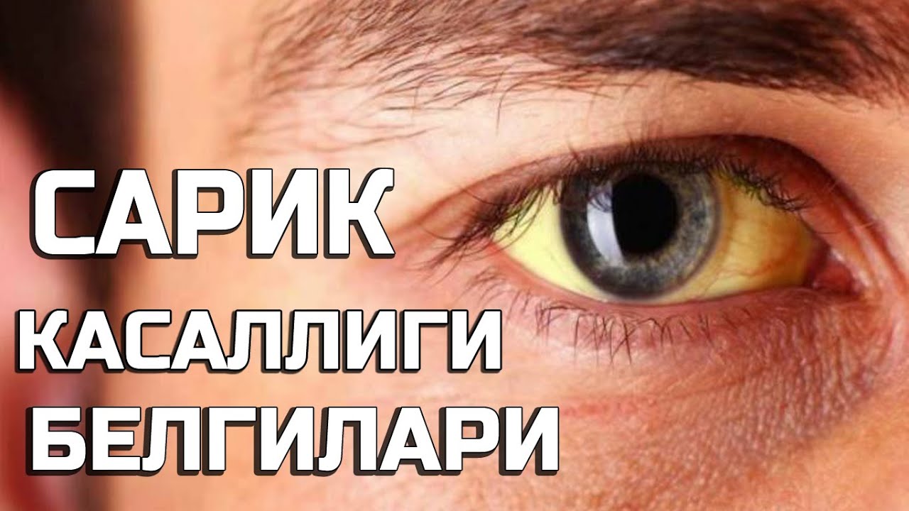 Сарик касаллигини белгилари пайдо булиши