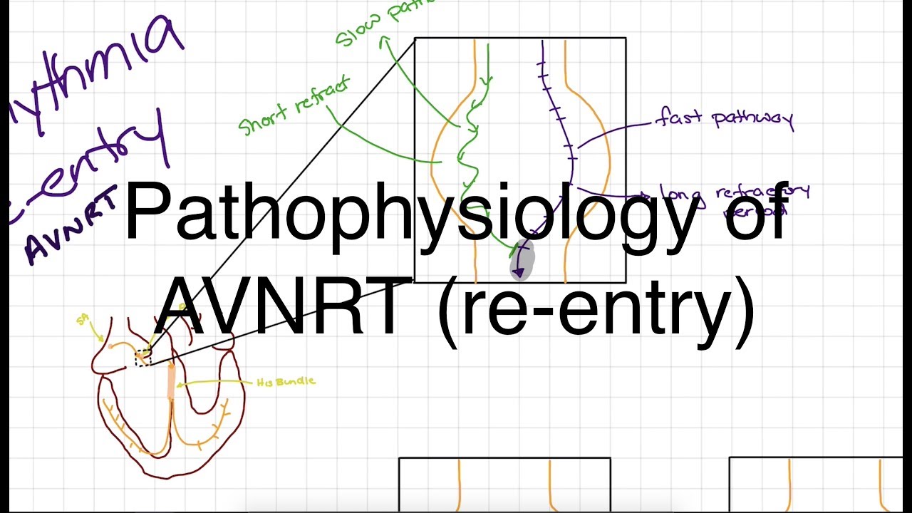 Pathophysiology of AVNRT