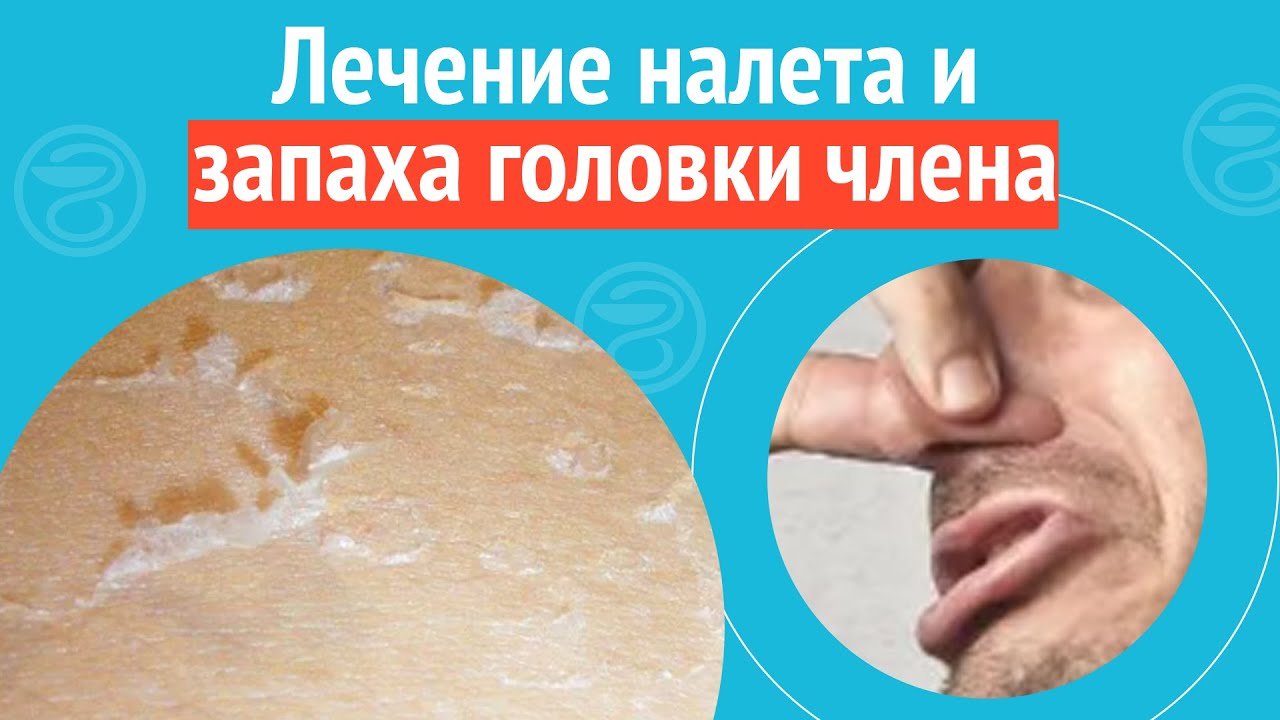 🩺 Лечение налета и запаха головки члена. Клинический случай №1127