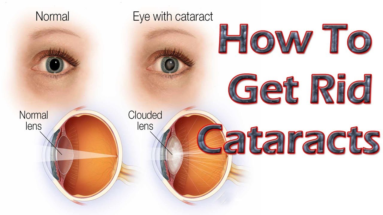 Katarata: Mabisang Lunas. Pampatak o Operasyon – ni Doc Yul Dorotheo (Eye Doctor) #3