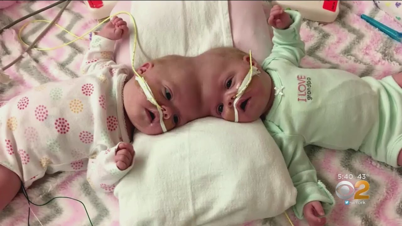 Formerly Conjoined Twins Now Thriving Following High-Tech Surgery