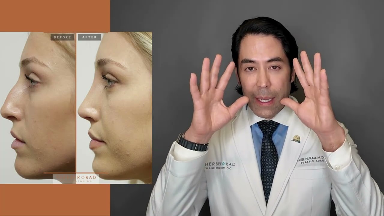 OPEN RHINOPLASTY