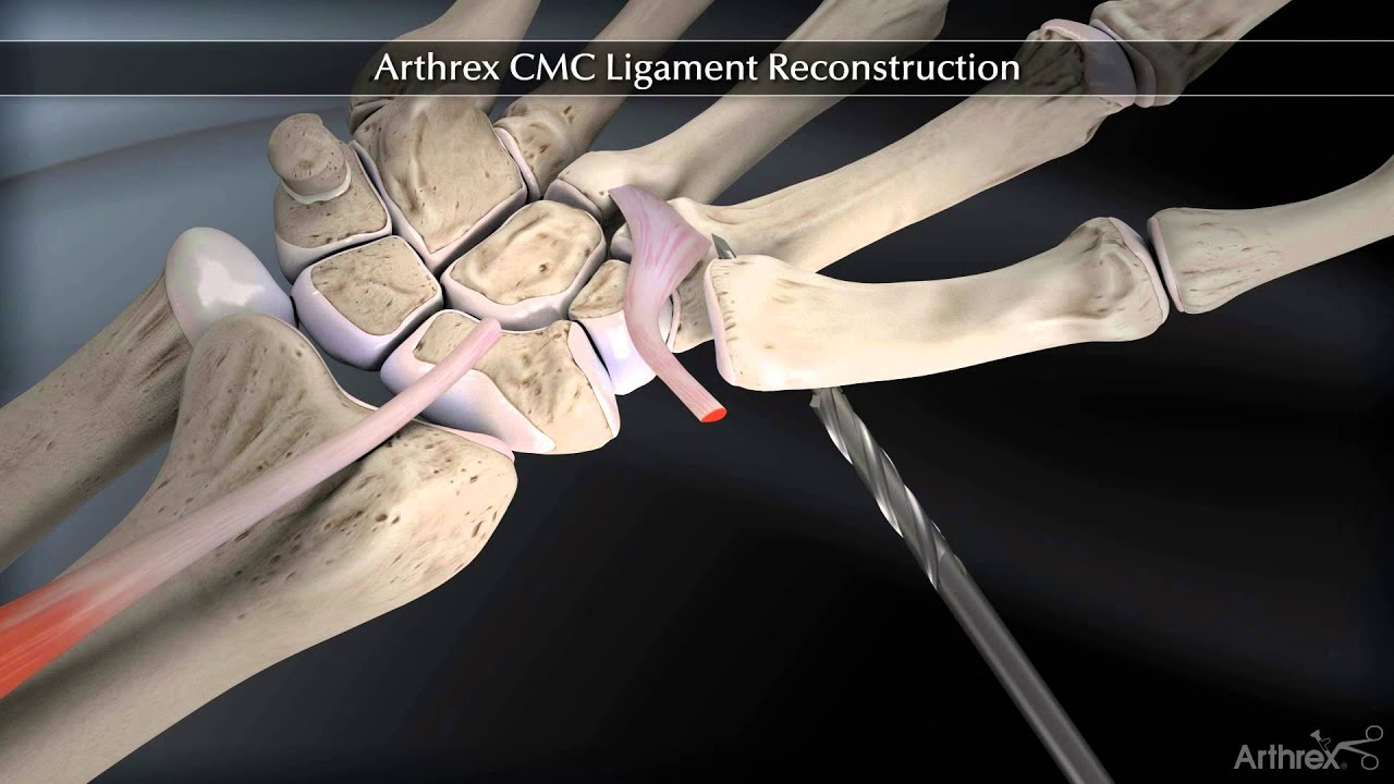 Arthrex CMC Ligament Reconstruction