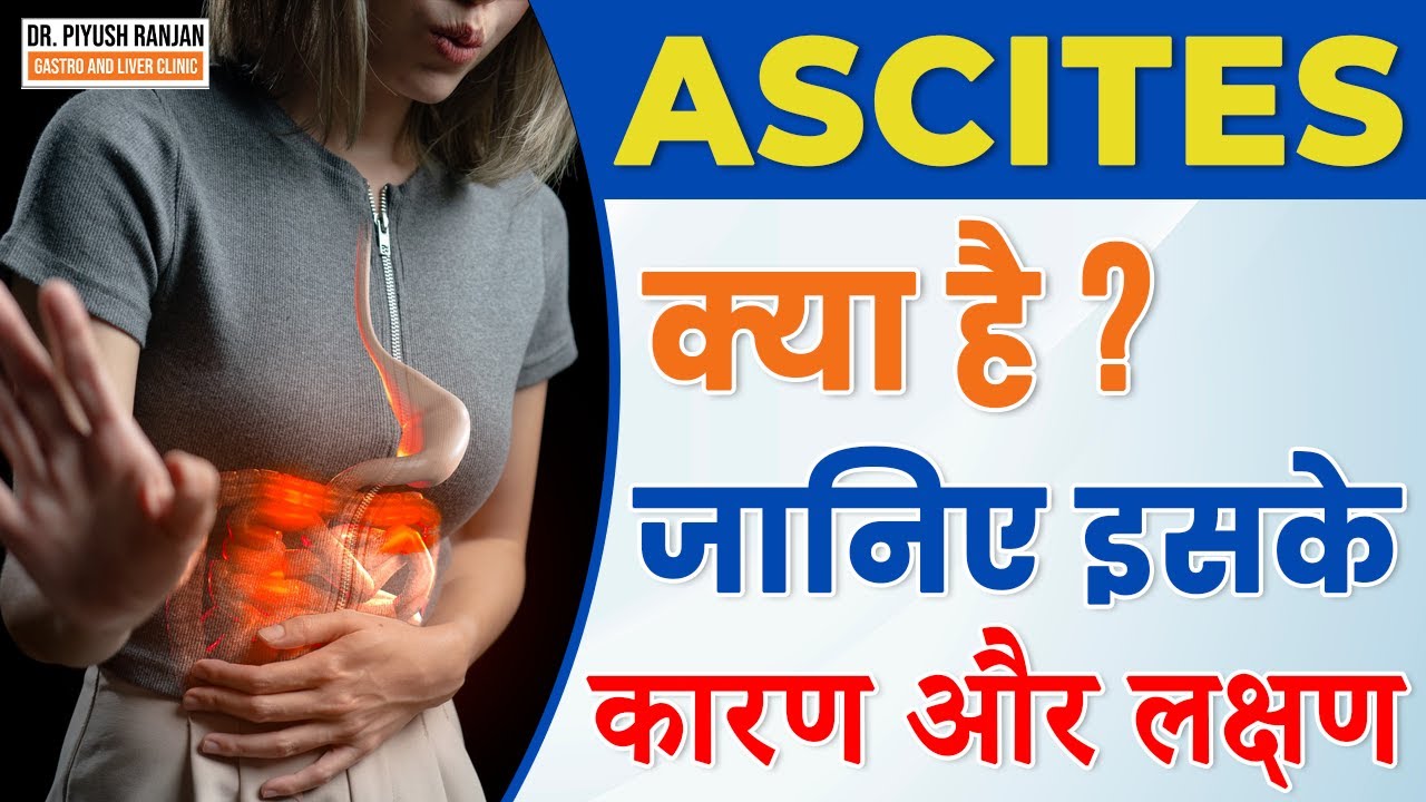 Ascites (पेट में पानी भरना) | Ascites क्या है? | Ascites लक्षण, कारण, और इलाज in Hindi