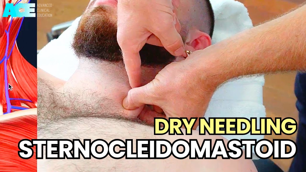 Dry Needling: Sternocleidomastoid