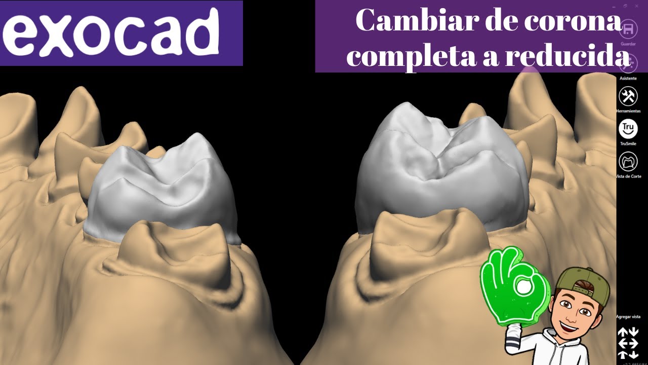 Como cambiar una corona completa a reducida en exocad🚀(Desde el diseño)