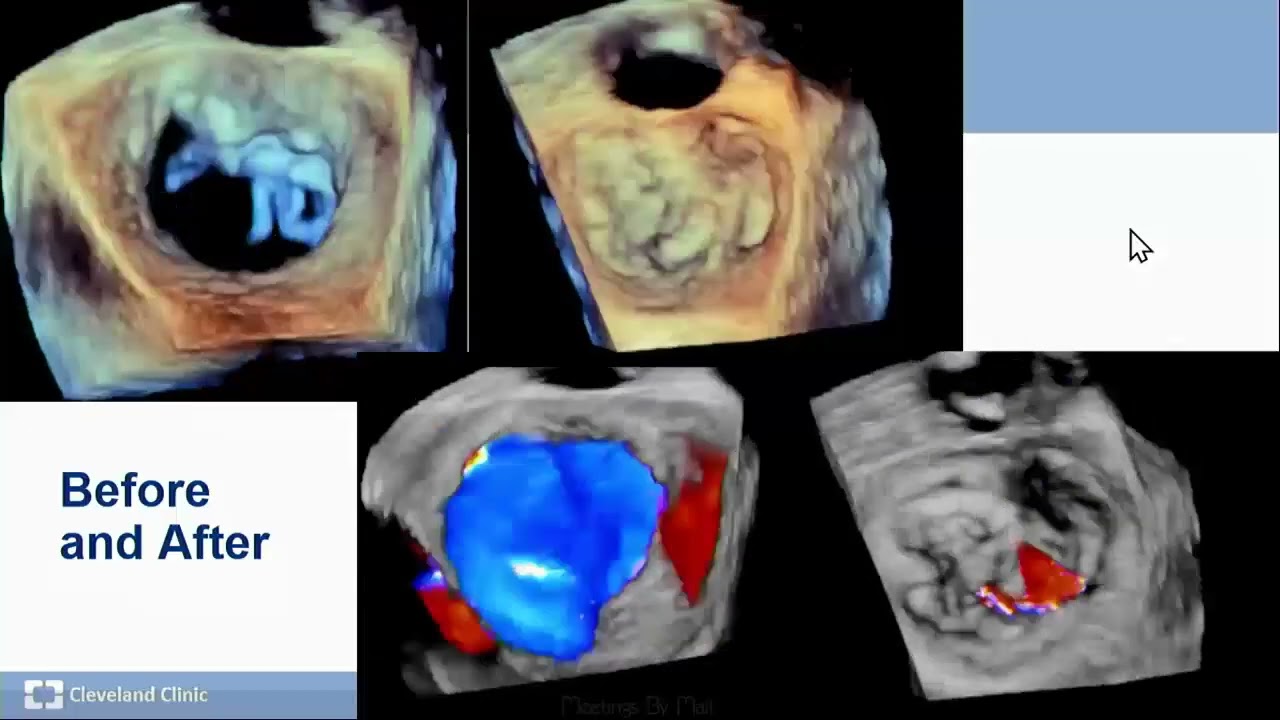 Ss 1 When Should Percutaneous Approaches Be Considered for Primary and Secondary MR?