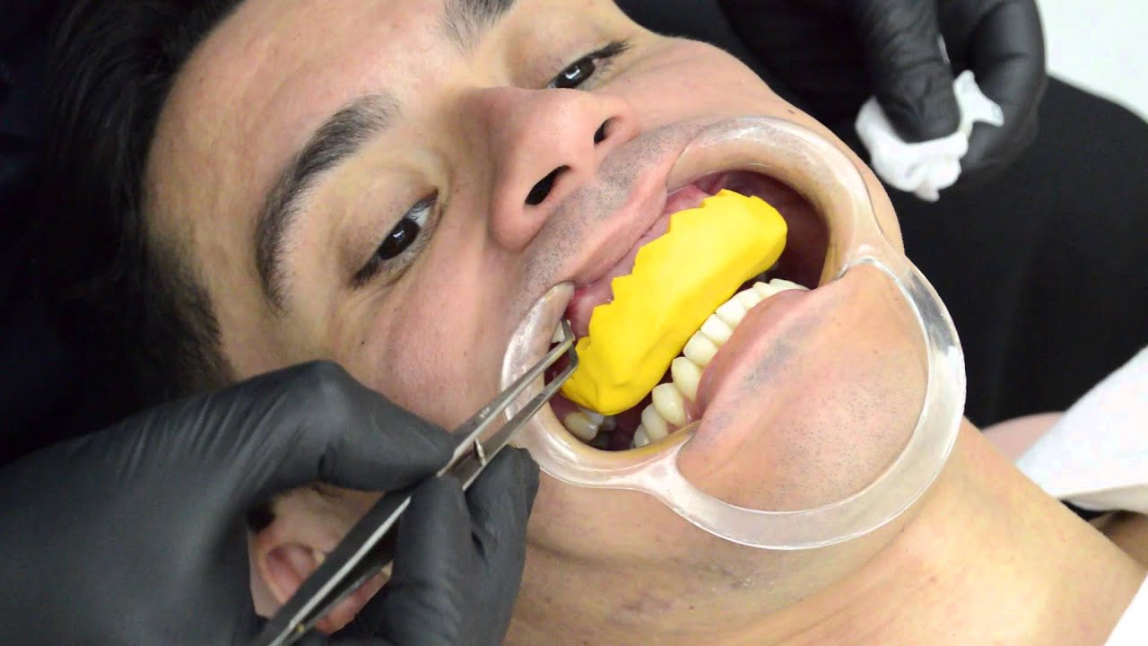 Mock-up estético / guia clínico (test-drive do sorriso)