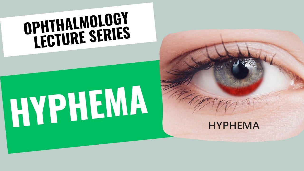 Hyphaema | Hyphema | Ophthalmology Lecture Series | Lecture 15
