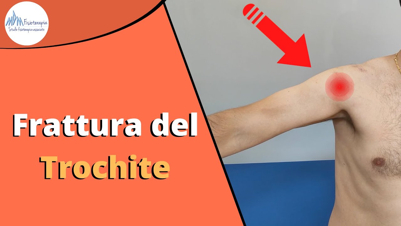 Frattura Trochite | LA frattura alla spalla più frequente