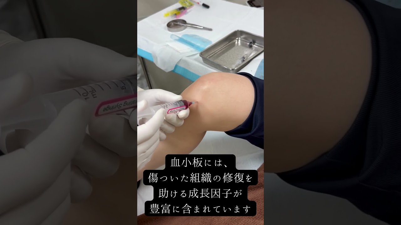 話題の再生医療【膝のPRP注射】　#変形性膝関節症#変形性ひざ関節症 #再生医療#prp #ひざの痛み #池袋 #東京ヴェインクリニック#prp #prptreatments