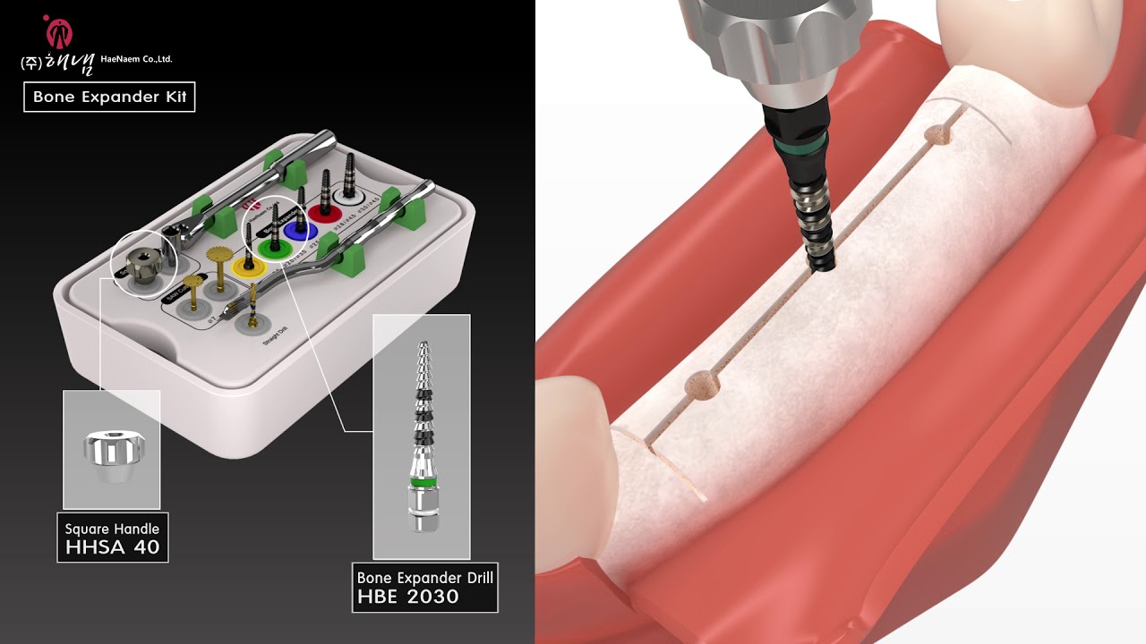 Bone Expander Kit - Haenaem Co., Ltd.