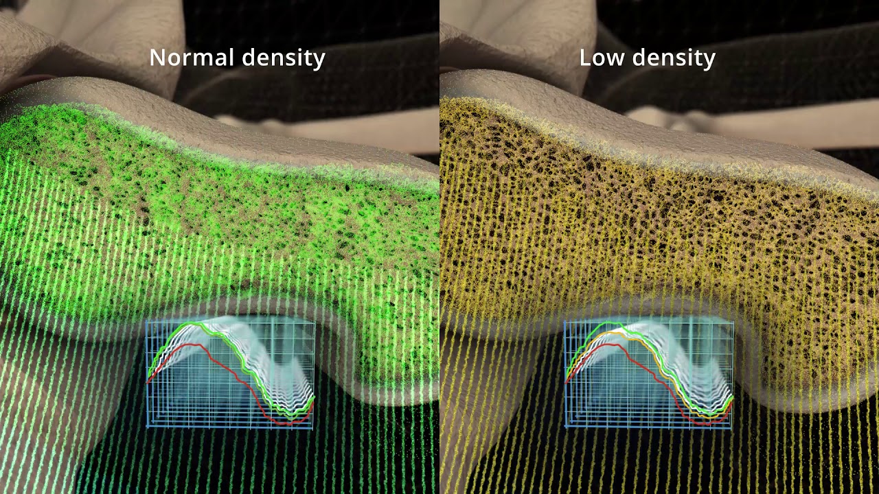 Echolight: REMS Technology Femur