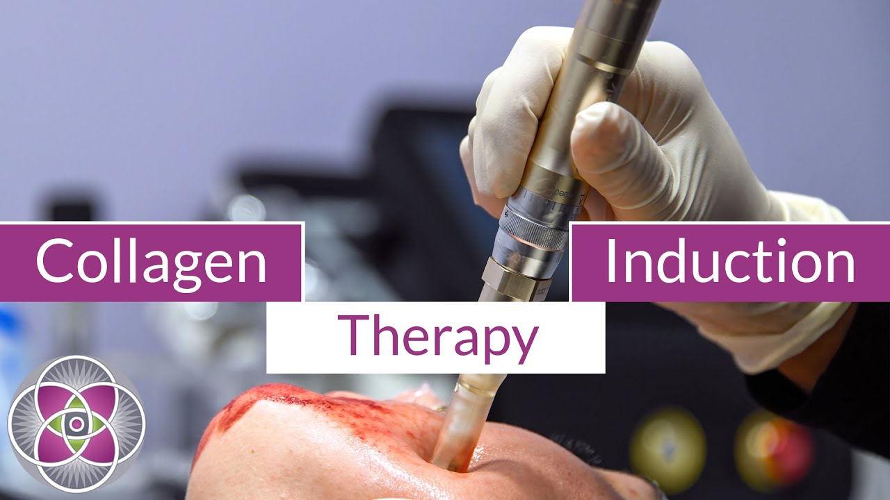 Collagen Induction Therapy Before & After Micro Needling