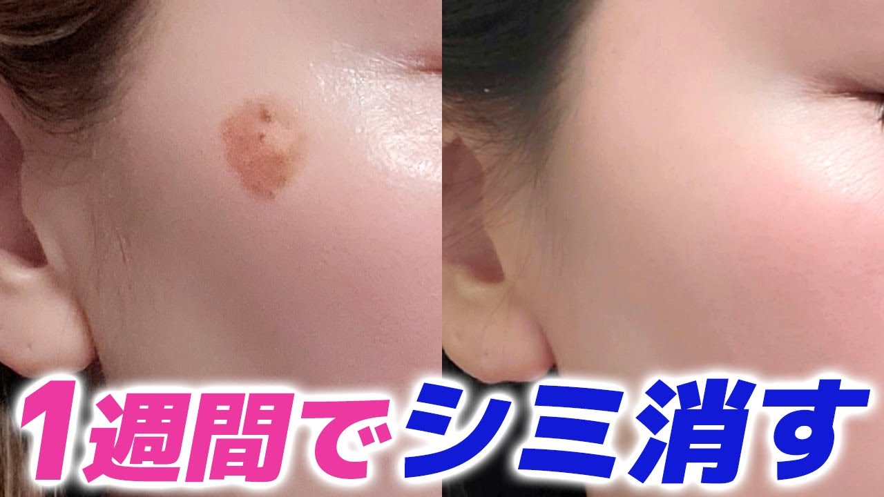 【実話】私が1週間でシミを取った方法【シミ消す方法】