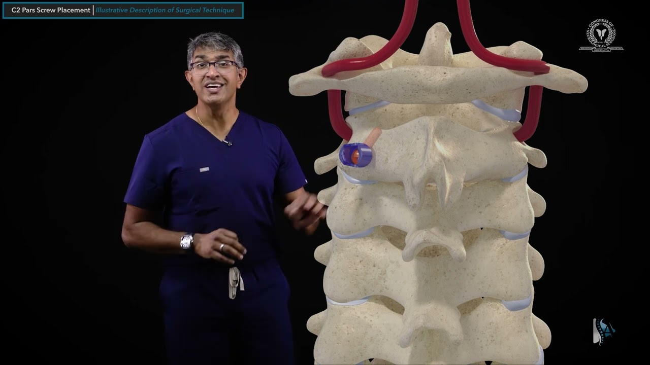 Surgical Techniques: C2 Pars Screw Placement