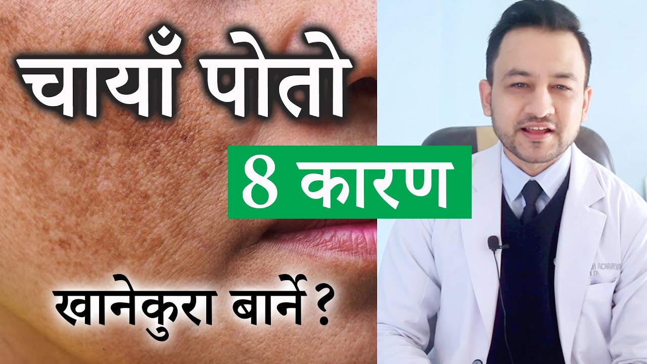 चायाँ पोतोका ८ कारणहरु । डा. प्रकाश आचार्य  | 8 causes of Melasma