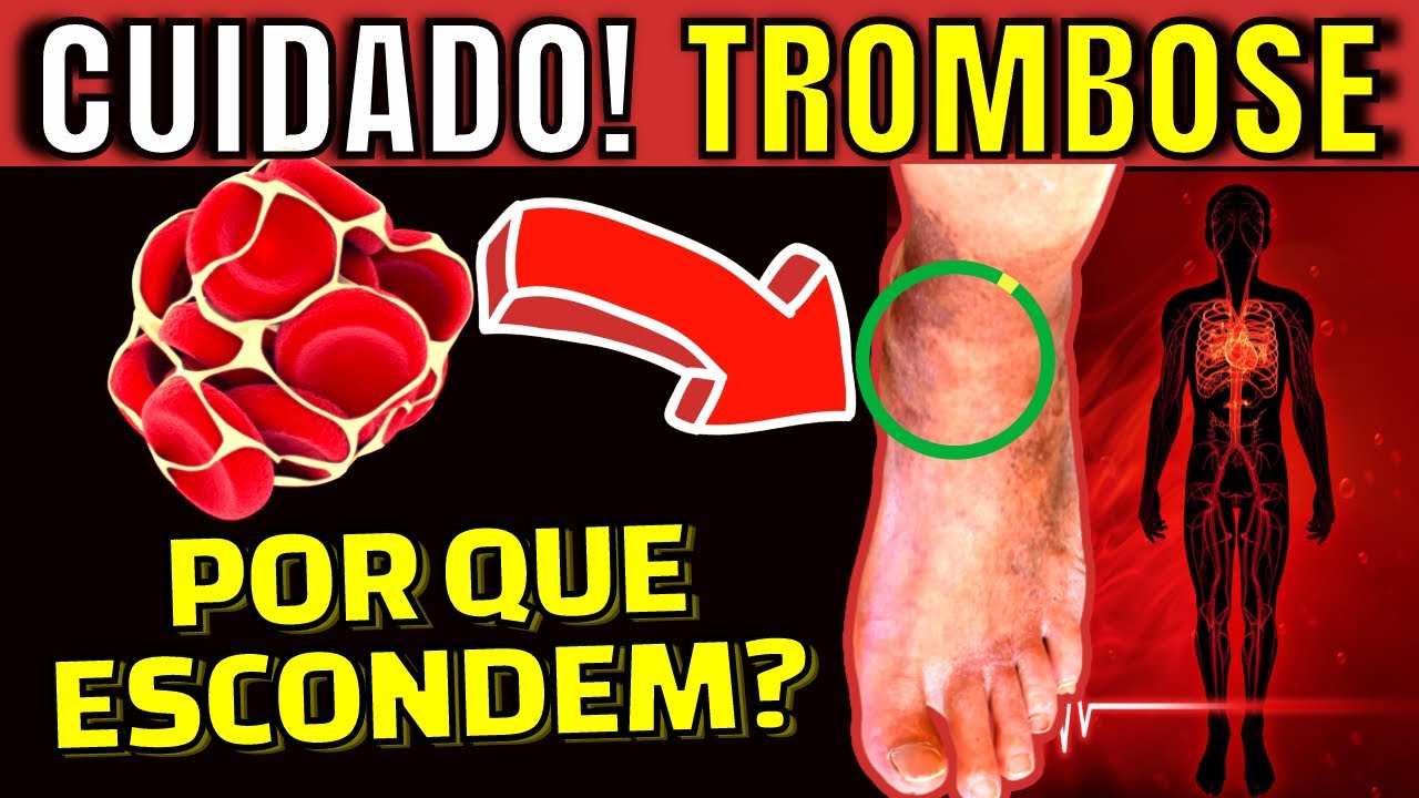 Como PREVENIR a TROMBOSE nas PERNAS | 7 ALIMENTOS QUE MELHORAM A CIRCULAÇÃO SANGUÍNEA