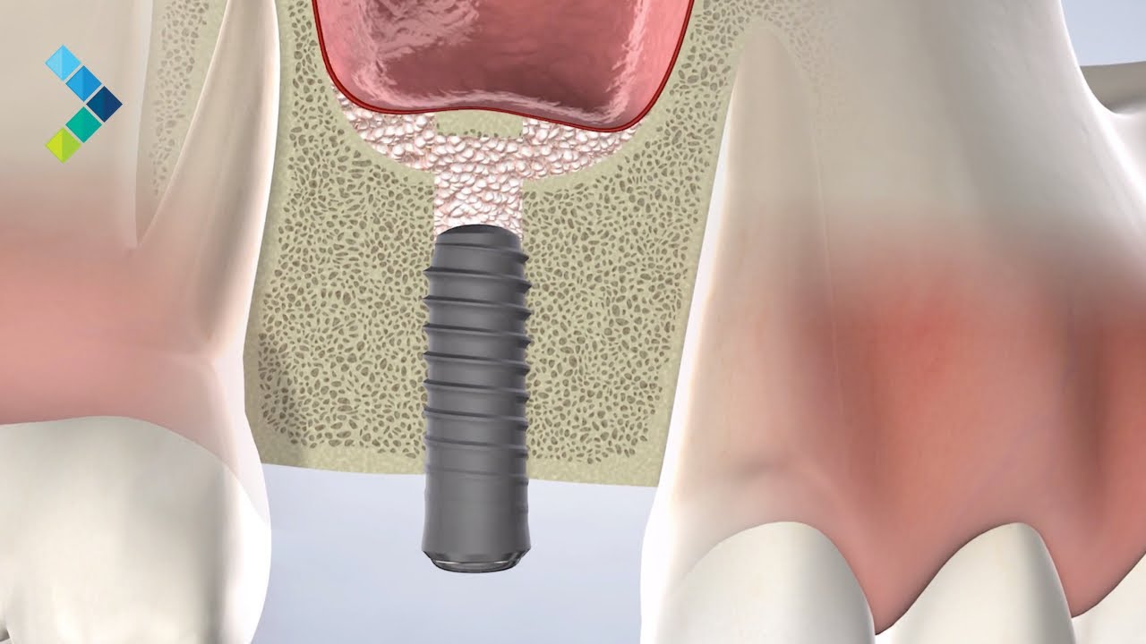 Bone Grafting in Louisville, KY