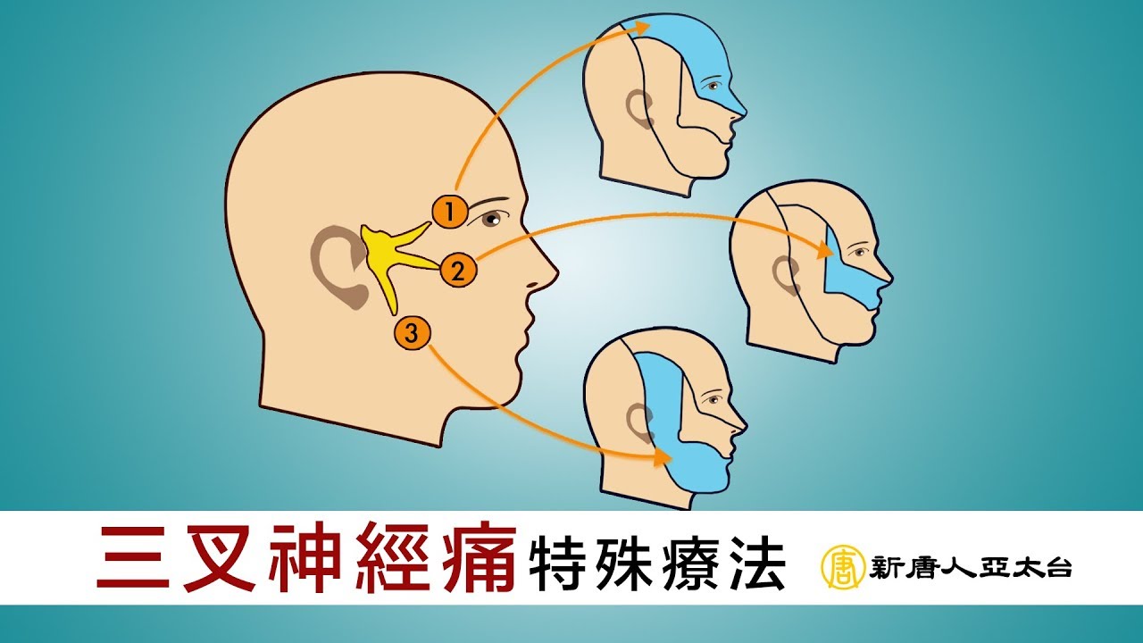 不再受電擊般的三叉神經痛之苦 中醫快速療法治這「天下第一痛！」 | 談古論今話中醫(421)