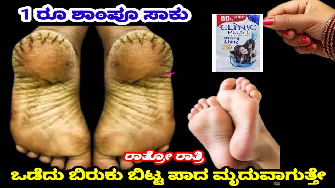 ಶಾಂಪು  ಸಾಕು ಒಡದ ಹಿಮ್ಮಡಿ ಮಾಯ ಒಂದೇ ರಾತ್ರಿಯಲ್ಲಿ 100% natural remedy/home remedy for crack heels.