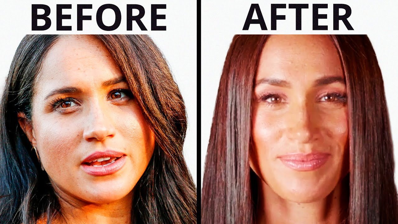 Meghan Markle's Royal Transformation | Plastic Surgery Analysis