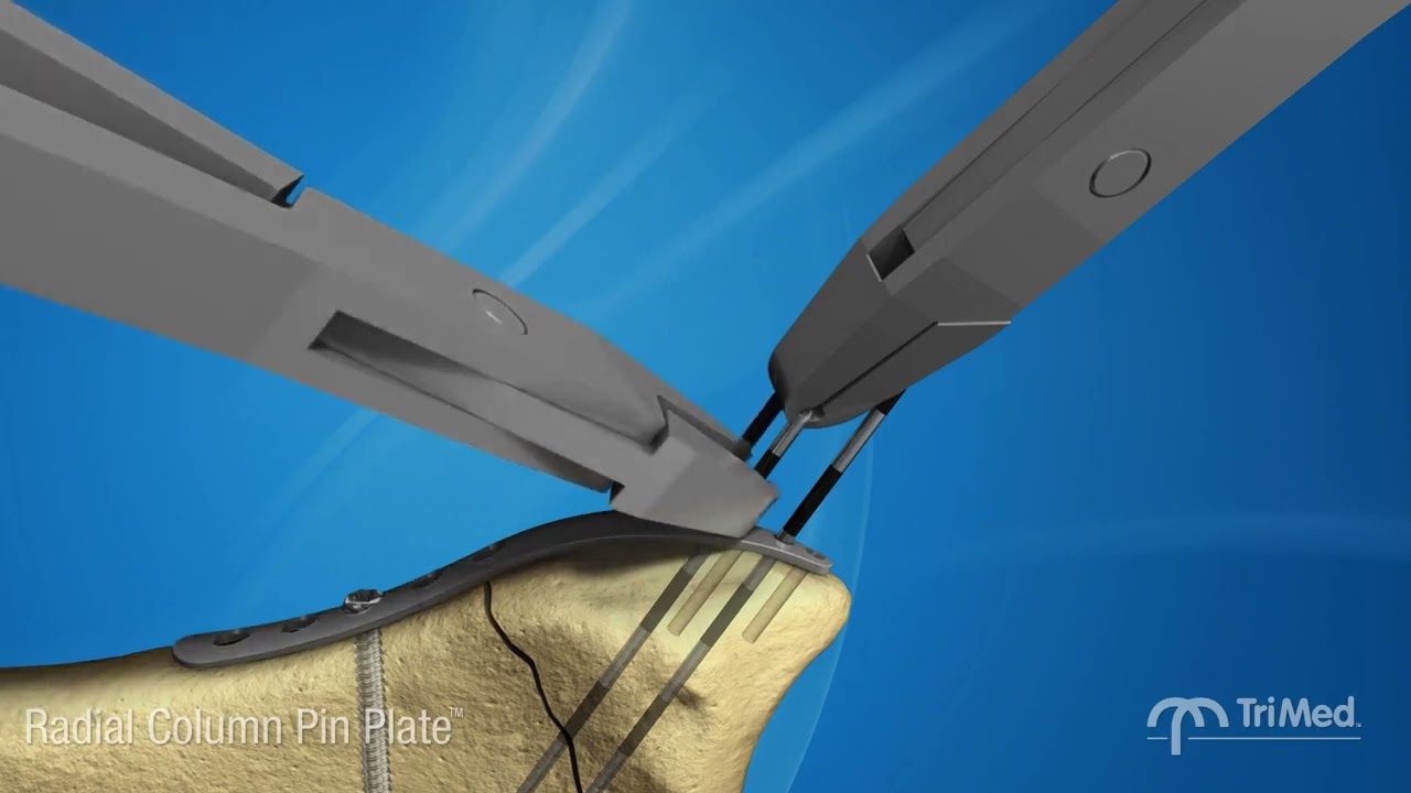 TriMed Radial Column Pin Plate: True Fragment Specific Fixation