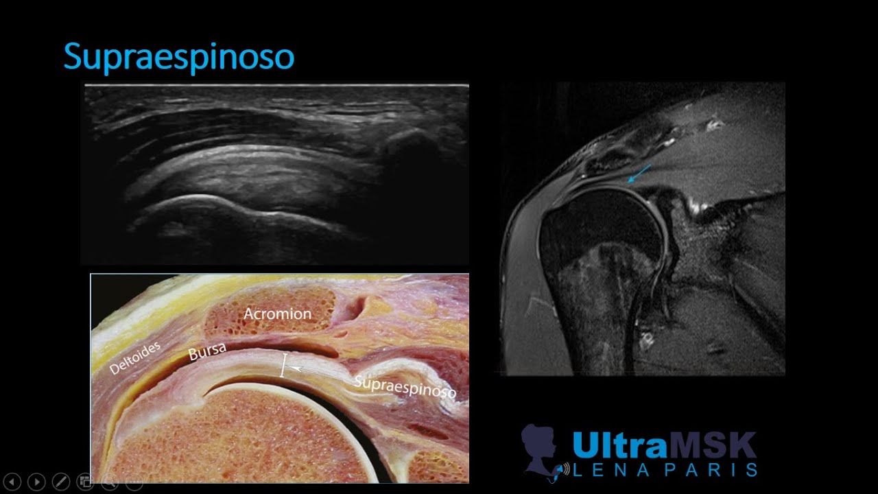 SONOANATOMIA DEL MANGUITO ROTADOR FÁCIL/ ANATOMIA ECOGRÁFICA DEL MANGUITO ROTADOR.