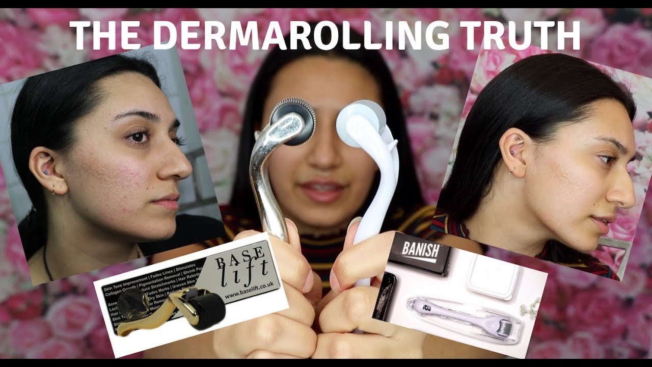 DOES DERMAROLLING EVEN WORK!? HONEST 2 MONTH UPDATE!