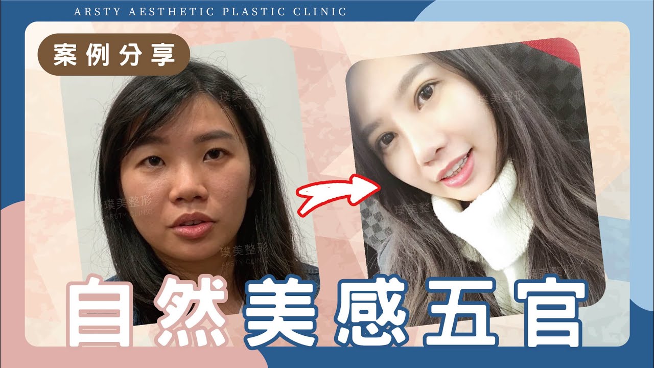 【縫雙眼皮+開眼頭+隆鼻+縮鼻翼+敲鼻骨】一站式整型～終於實現變美的夢想
