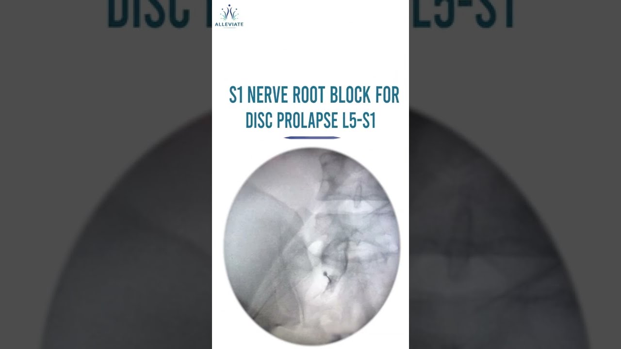 S1 Nerve Root Injection For Disc Prolapse ( L5 -S1) Under Fluoroscopy Guidance.