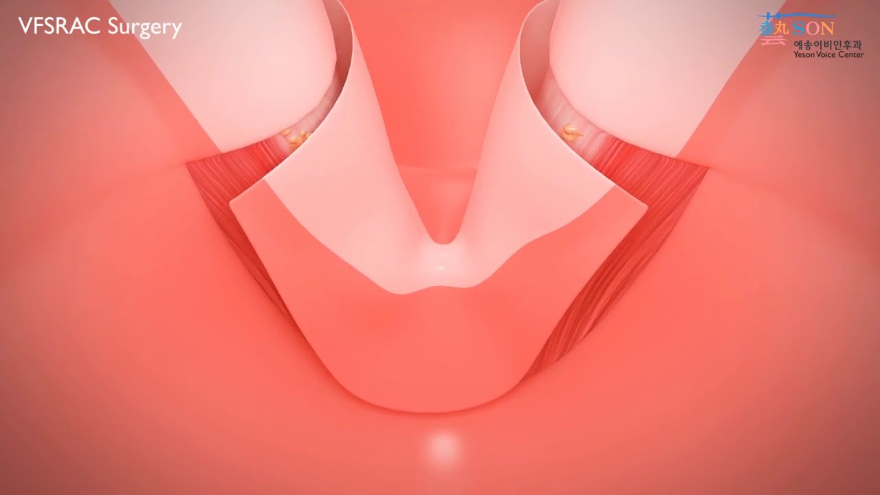 Yeson VOice Center   VFSRAC SURGERY TECHNIQUE IN 3D VIDEO