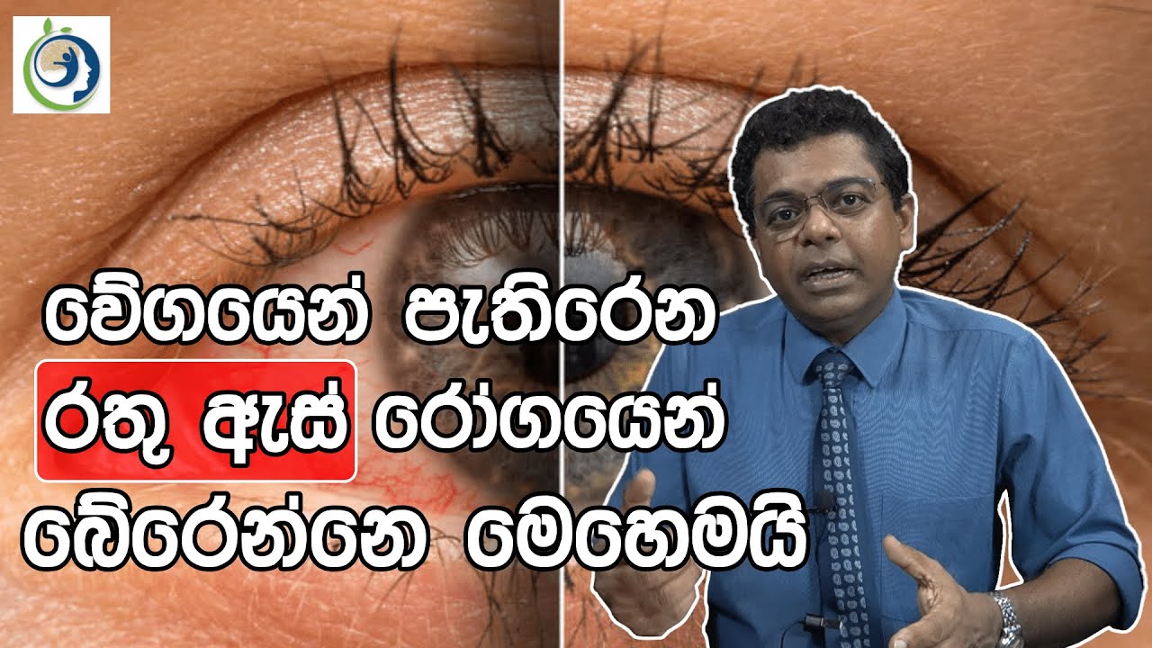 රතු ඇස භයානකයි! | Red Eye is Dangerous! | FOODbodyMIND