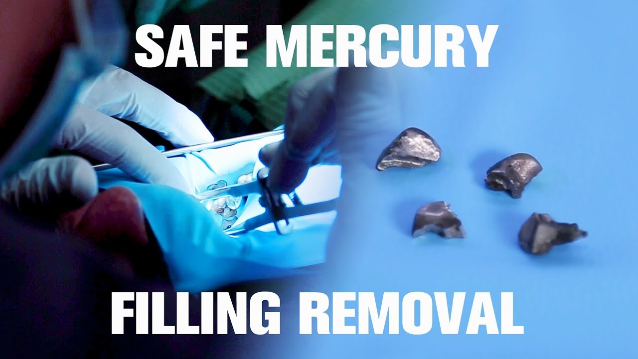 Mercury Filling Removal (SAFE) - DON'T replace your fillings UNTIL YOU WATCH THIS!