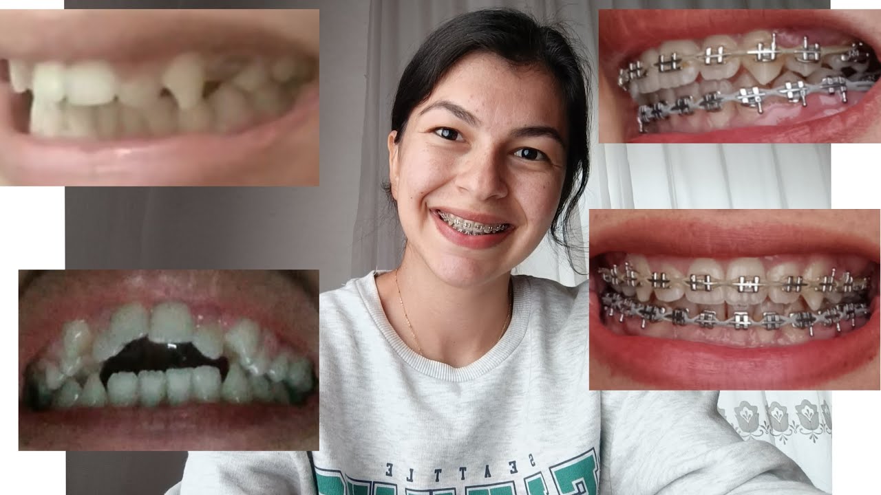 çekimli ortodontik tedavi sürecim-22&23 #dentistry #dişteli #dentist #orthodontist