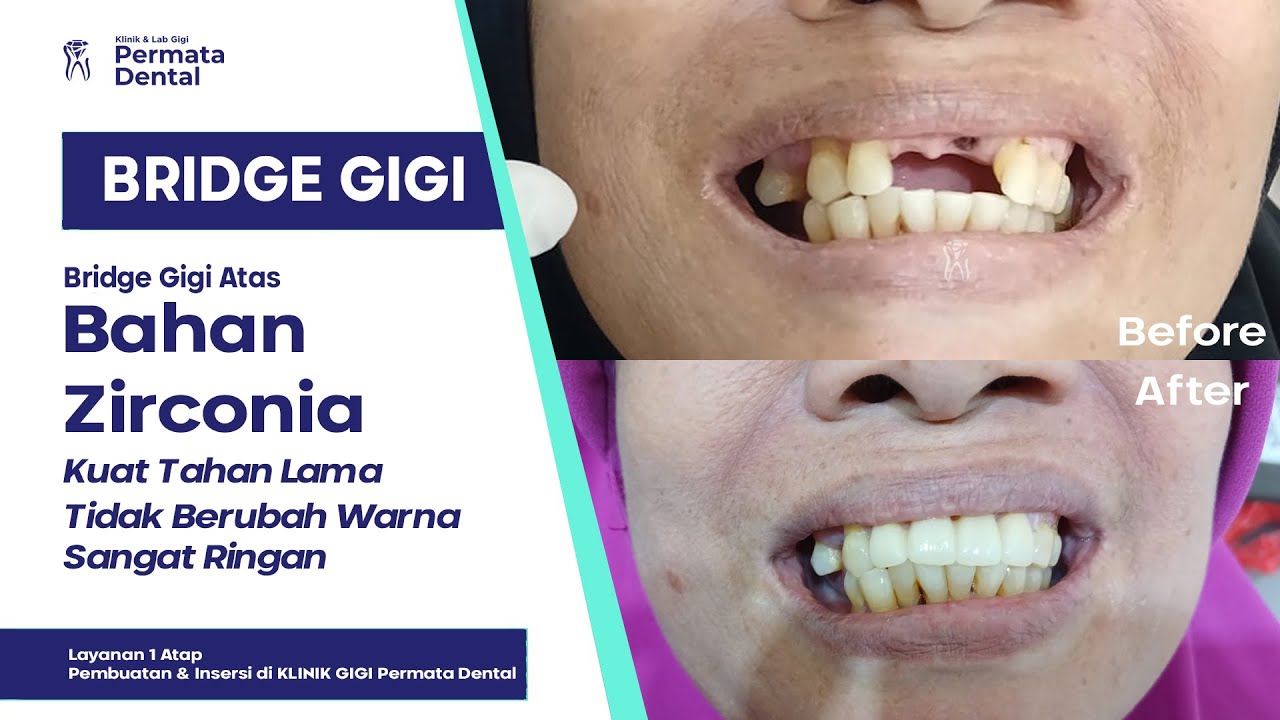 Proses Pembuatan & Pemasangan Gigi Depan Bridge Berbahan Zirconia di Permata Dental