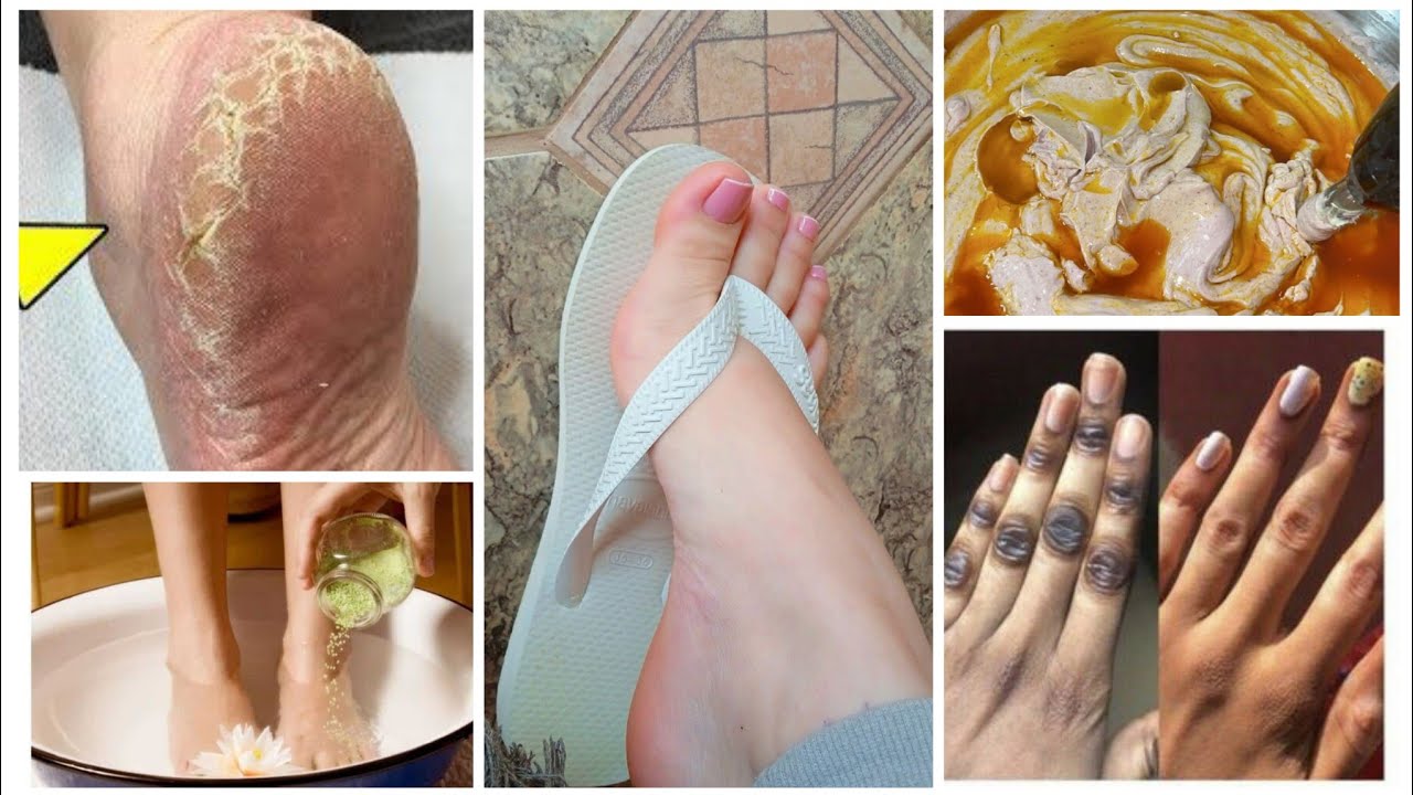 sida locadeyo lugaha cirbo jilicsan😱5 mins Remove Cracked Heels and Get Beautiful Feet