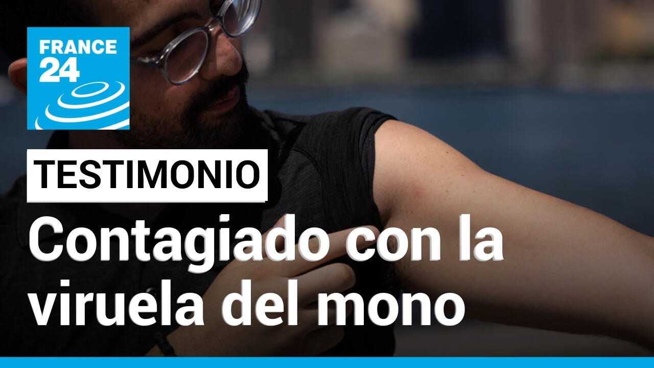 “El peor dolor de mi vida”: un estadounidense cuenta su experiencia con la viruela del mono